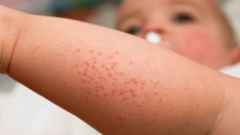 V rmeutslag Hos Bebisar F rebyggande Och Behandling Att Vara Mamma v-rmeutslag-hos-bebisar-f-rebyggande-och-behandling-att-vara-mamma