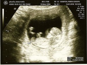 Innovativa sätt att upptäcka komplikationer under graviditeten