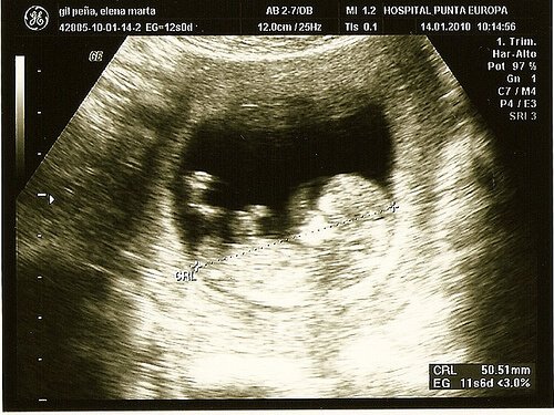 Innovativa sätt att upptäcka komplikationer under graviditeten