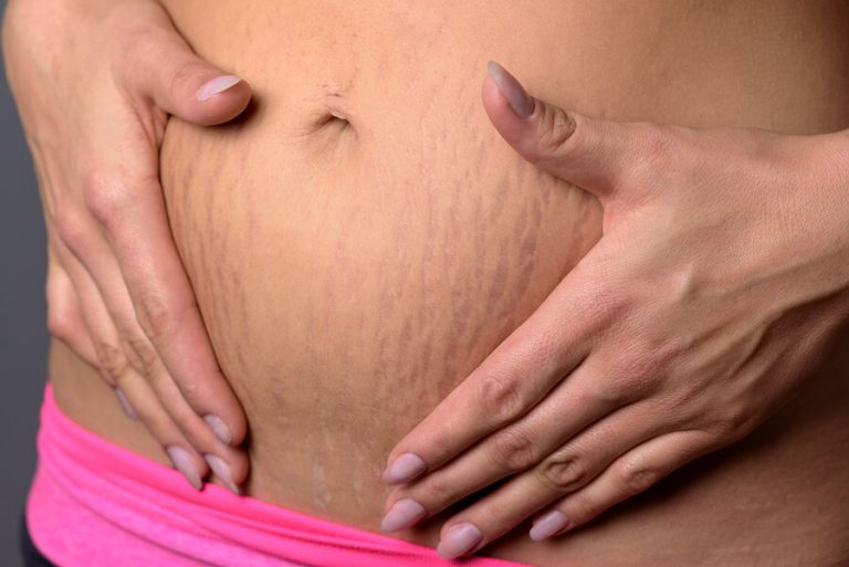 Hur man blir av med hudbristningar under graviditeten