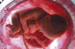 Foster i livmodern med navelsträng