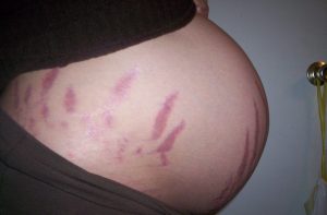 Varför får man hudbristningar när man är gravid?
