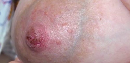 Såriga och spruckna bröstvårtor.