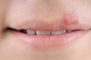 Herpes hos barn: Symtom, orsaker och behandling