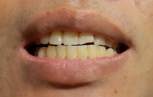 Uppkomsten av fläckar på permanenta tänder