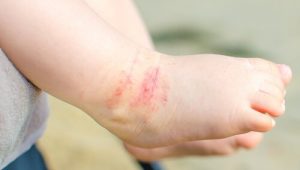 15 tips för att lindra atopisk dermatit hos barn