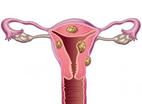 Livmodersfibroider och infertilitet