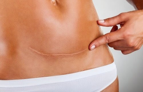 mage med ärr av ett kejsarsnitt efter förlossningen