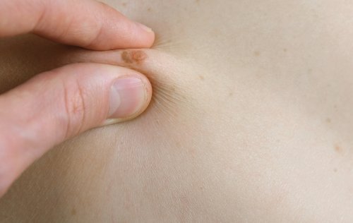 Identifiera leverfläckar