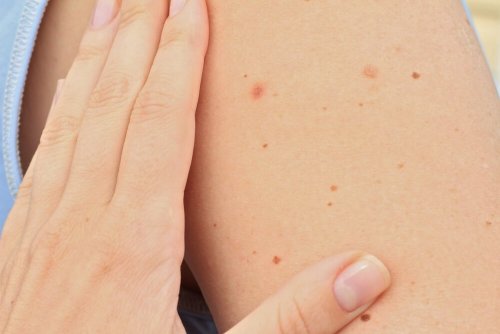Leverfläckar på hud
