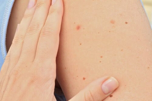 leverfläckar på hud