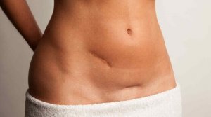 De senaste rönen för att göra ärr mindre påtagliga