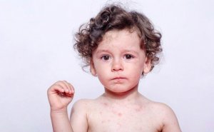 Svettallergi hos barn: symptom och behandling