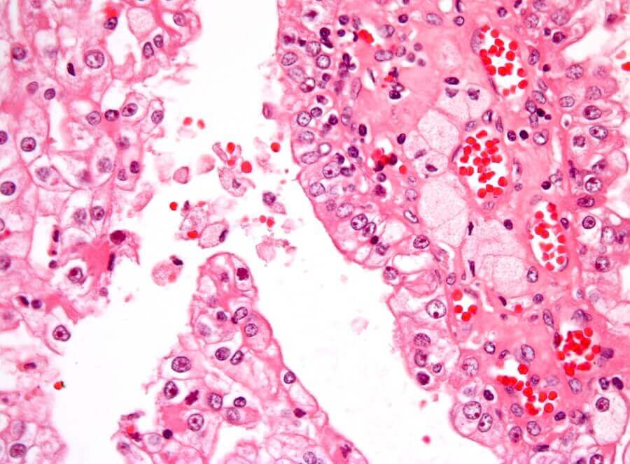 mikroskopisk bild på njurcancer
