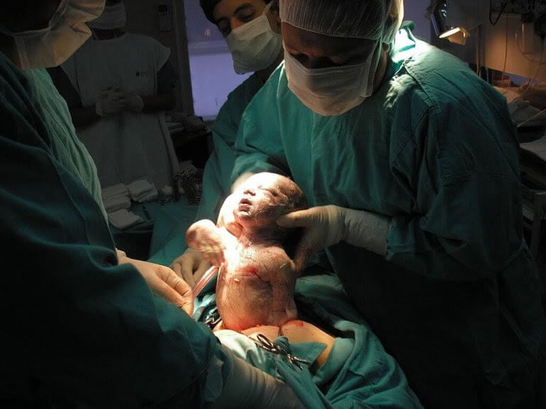 förlossning där barnet tas upp ur moderns kropp av operationsklädd person