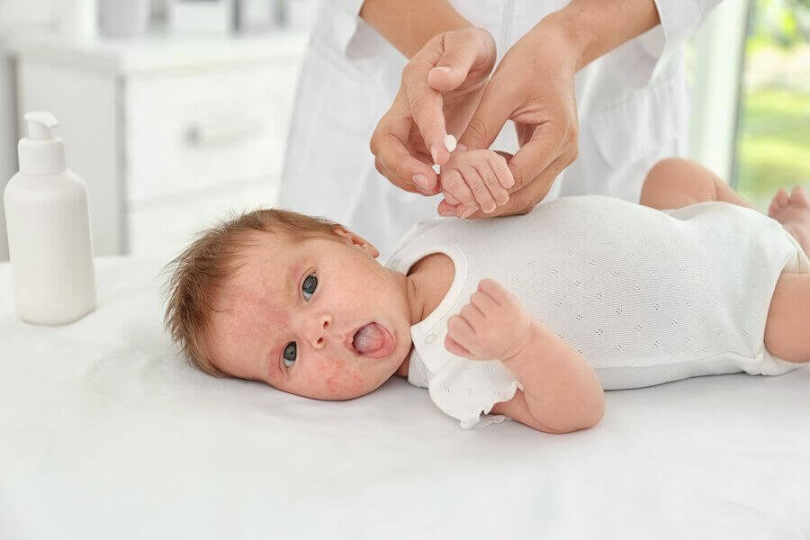 eksem hos barn: baby med eksem på kinderna