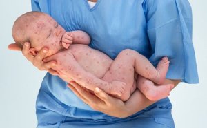Mässling hos barn: Symptom, behandling och förebyggande åtgärder
