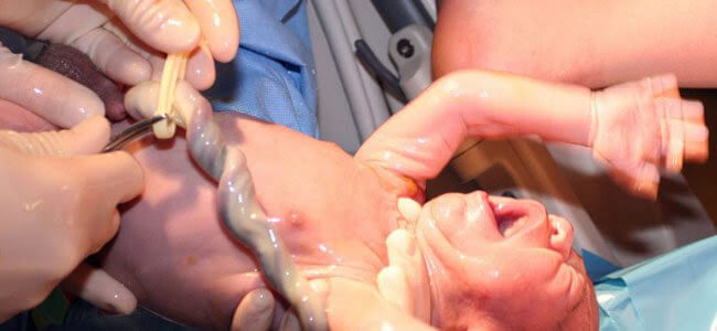 baby som just blivit född med navelsträng