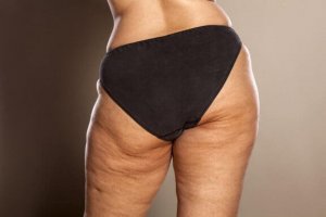 Vet du hur man bekämpar celluliter?