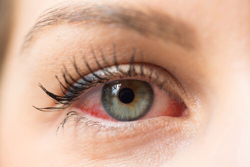 Hur du kan förhindra spridning av ögoninflammation