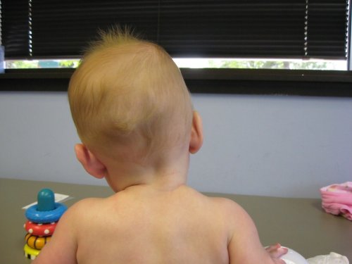 En bebis med skolios.