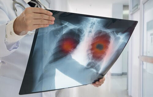 Cystisk fibros hos barn: läkare undersöker röntgenplåt på lungor