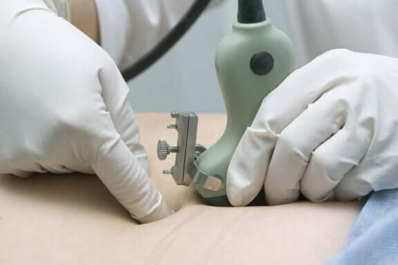 Amnioninfusion vid förlossning