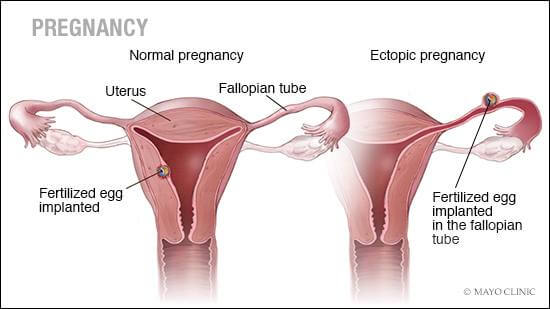 Illustration på en livmoder och ektopisk graviditet.