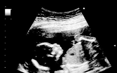 foster i den 18:e graviditetsveckan