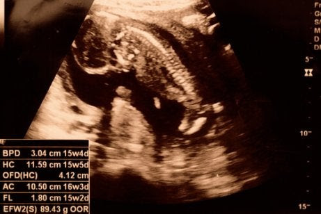 ultraljudsbild från den femtonde veckan av graviditeten