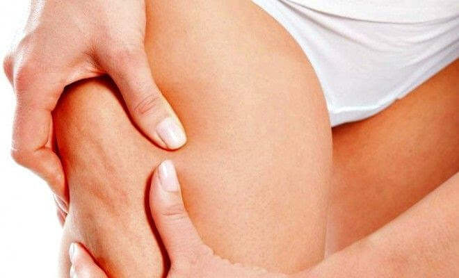 återhämta sig efter förlossningen: kvinna visar celluliter på lår