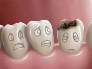 Hål i tänderna och hur man förebygger dem
