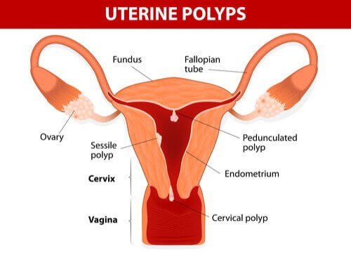 Polyper i livmodern: illustration