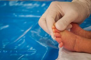 Pataus syndrom hos spädbarn: Orsaker, symtom och behandling