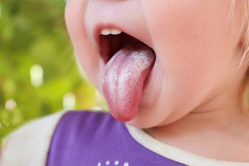 candidiasis på barns tunga
