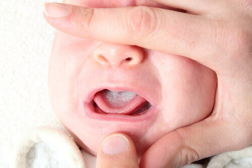 candidiasis på baby