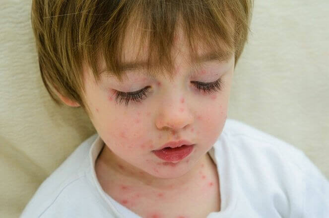 smittsamma sjukdomar: prickig pojke