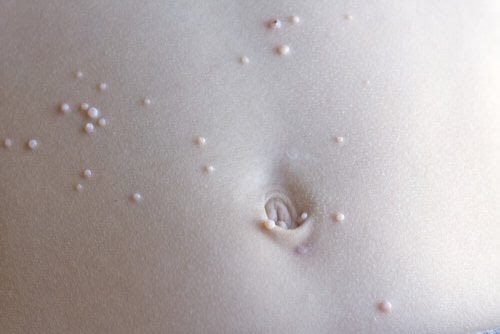 Vad du ska göra om ditt barn har molluscum contagiosum (MC)