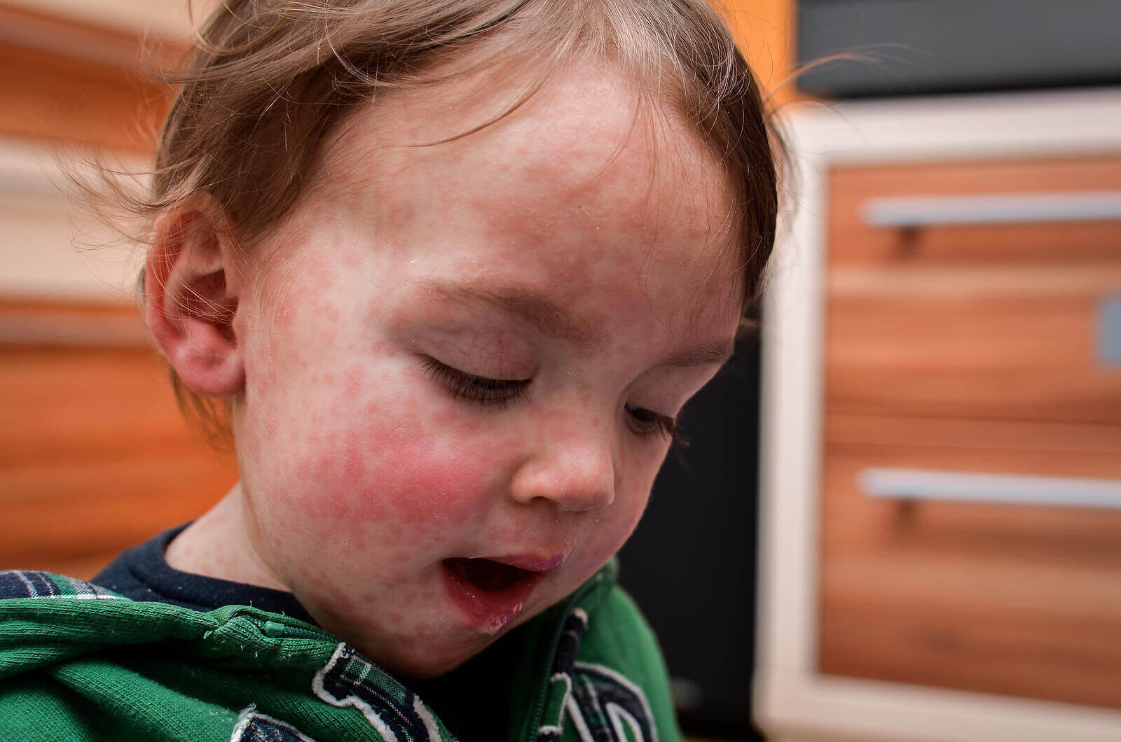 allergi mot komjölksprotein: barn med utslag i ansiktet