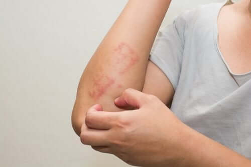 Psoriasis hos barn: Vad det är och hur barn påverkas