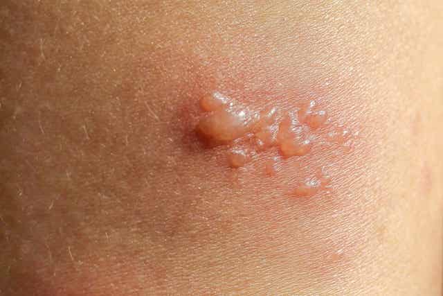 Blåsbildande autoimmun sjukdom på en kvinnas hud.