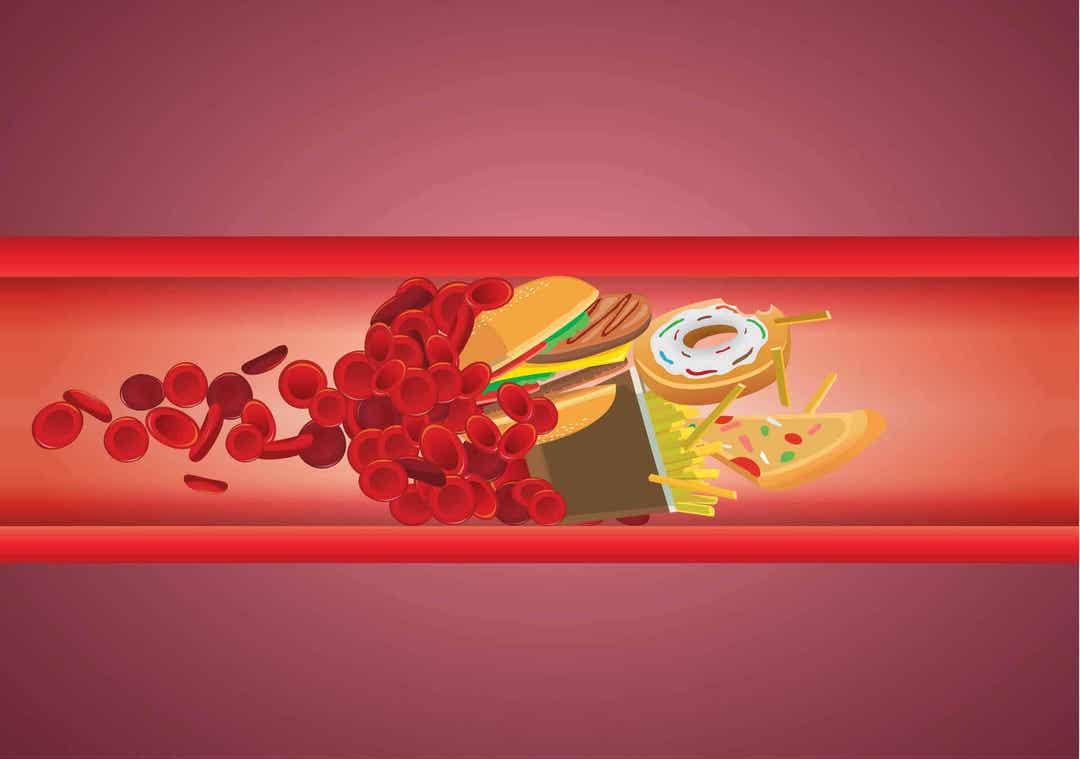 illustration av skräpmat i blodådra