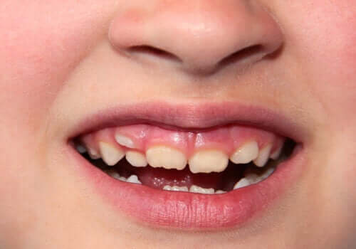 Felplacerade tänder hos barn: vad ska jag göra?