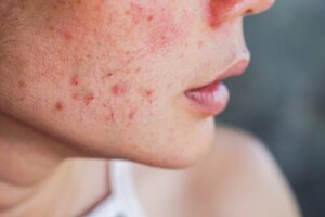 10 huskurer mot akne under graviditeten