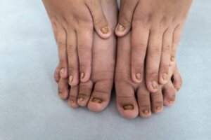 Vad innebär färgförändringar i barns naglar?