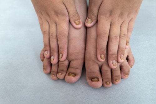 Vad innebär färgförändringar i barns naglar?