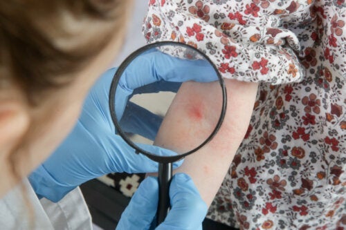 Naturläkemedel mot atopisk dermatit hos barn
