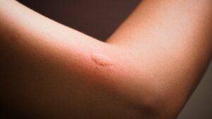 Guide för att identifiera insektsbett hos barn