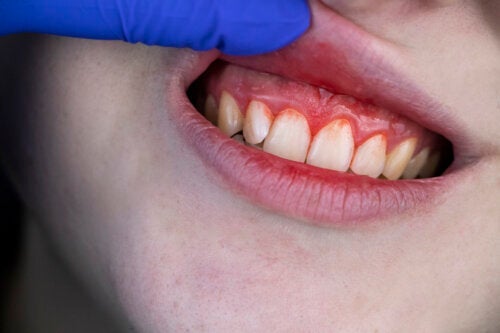 Vad du ska göra om ditt barns tandkött blöder