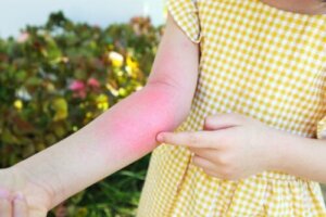 10 tips för behandling av kontakteksem hos barn